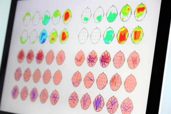 EEG - quantitative EEG